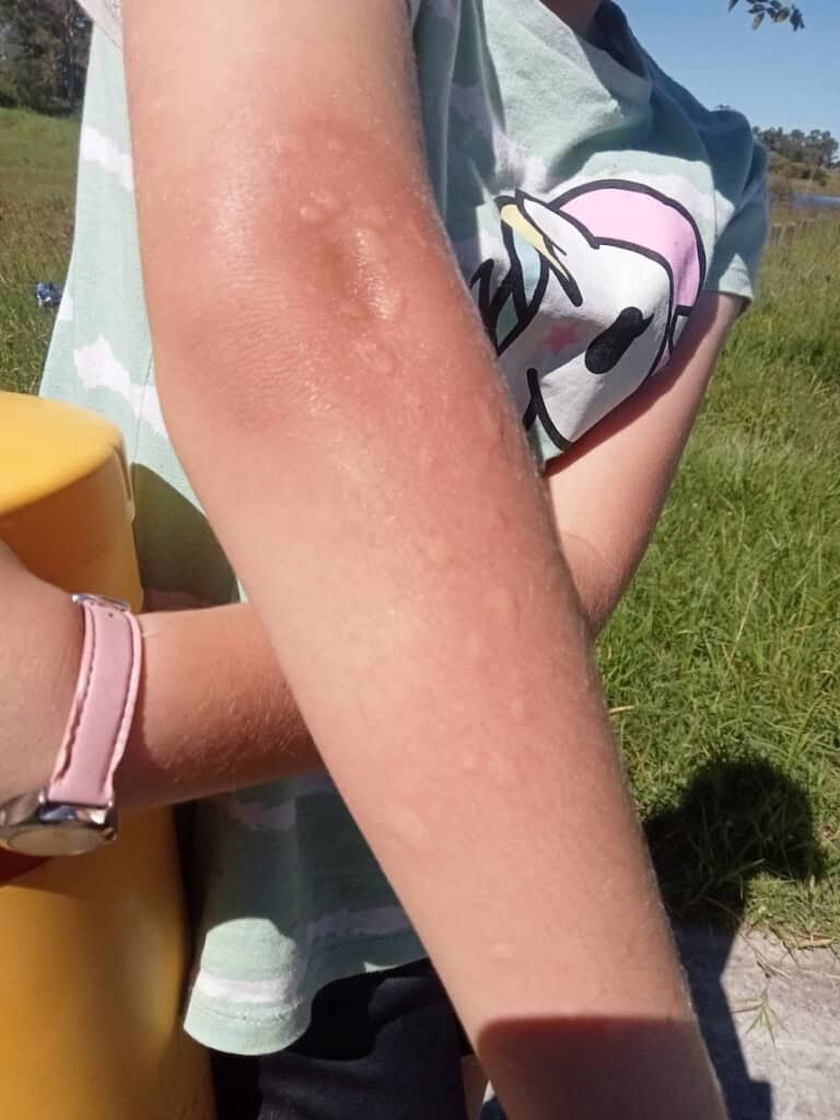 Lily, 11, turn out to be as soon as playing in a park when fire ants swarmed her physique