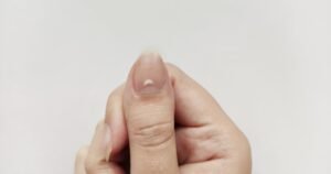 What Are Those White Spots on Your Nails?