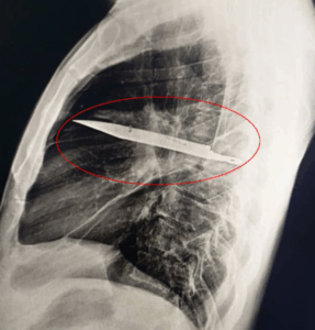 Man with Sore Nipple Shocked to Learn He Had Knife Blade in His Chest for 8 Years